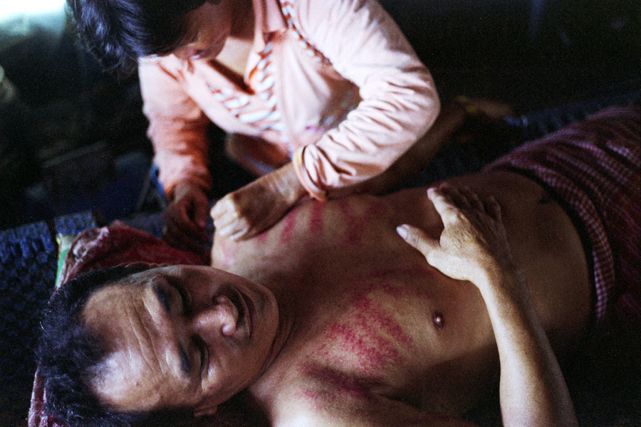 Kompong Luong, Cambodia 2012: kos khyal (coin scraping) in a mixed Vietnamese/Cambodian floating village on Tonle Sap. This traditional treatment of Chinese 
origin is believed to cure nearly everything from chronic cough to carpal tunnel.